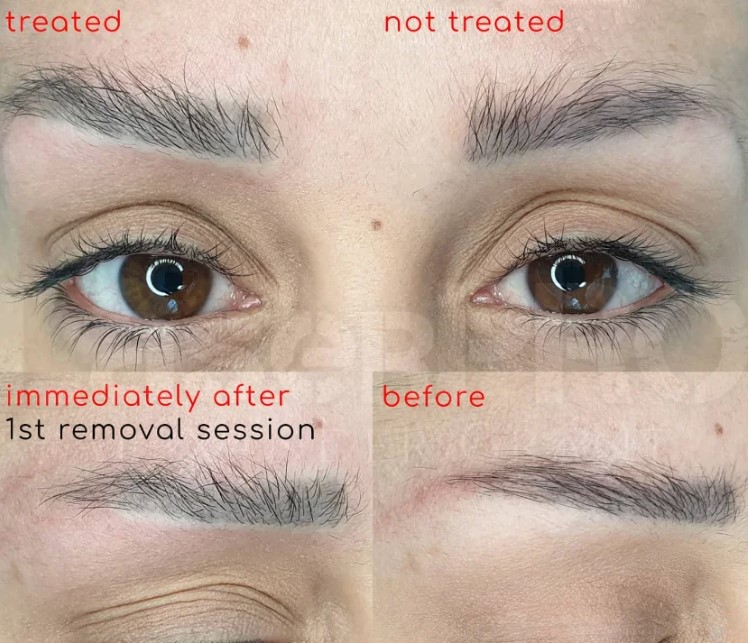 Eyebrow Tattoo Laser Removal Embrace Your Natural Brows