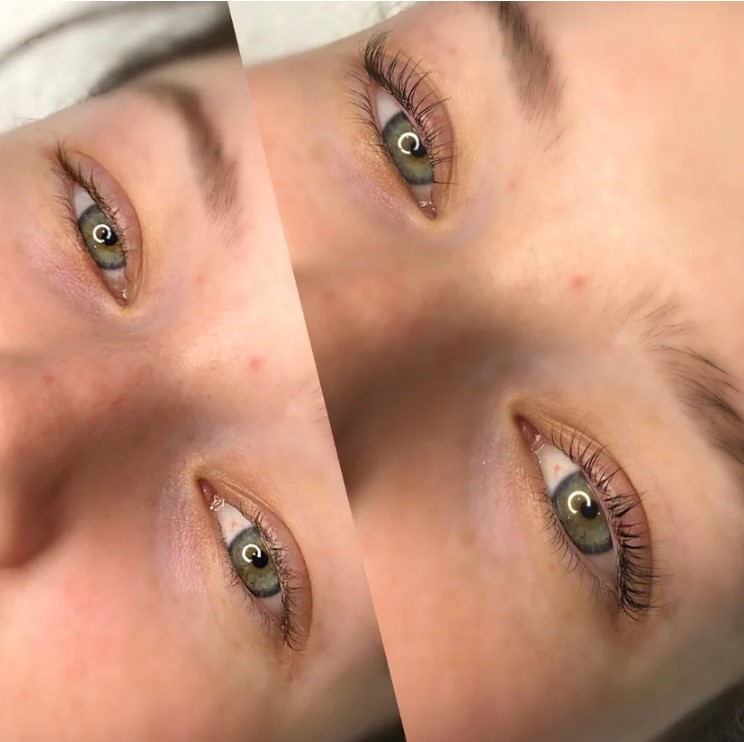 Saline Eyebrow Tattoo Removal The Key to Perfect Brows Beauty Begins