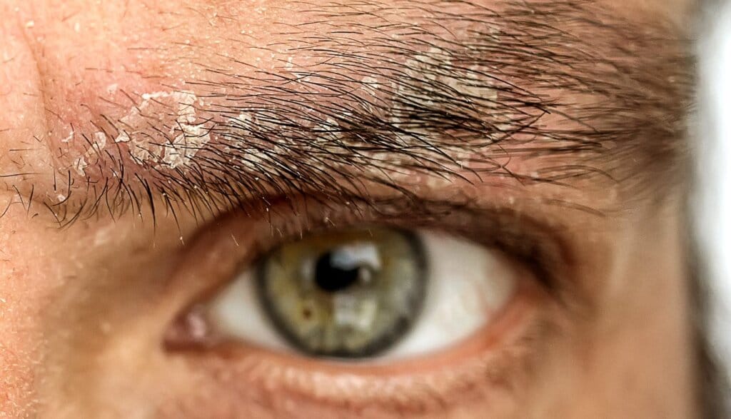 eyebrow-dandruff-treatment-effective-solutions-for-flaky-brow